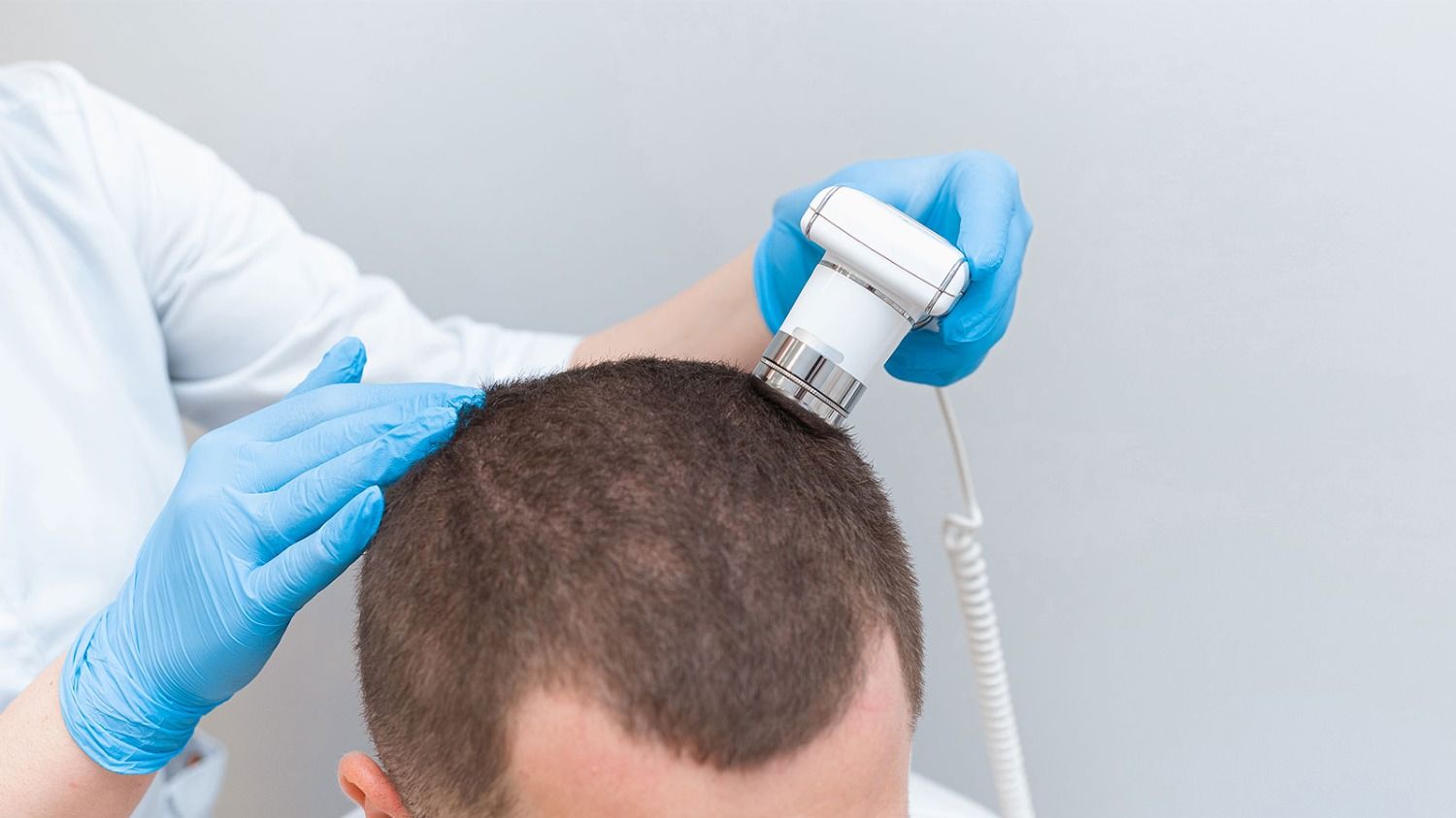 Shock loss après une greffe de cheveux: pourquoi vos cheveux tombent et quand repoussent-ils ?