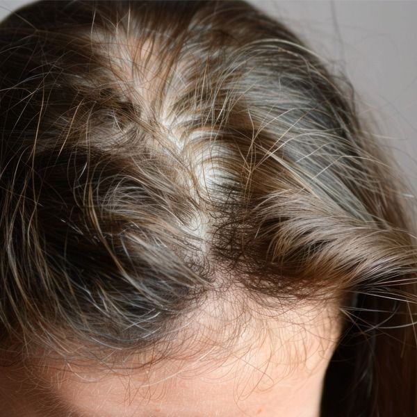 le_prp_est_il_adapte_a_tous_les_types_de_perte_de_cheveux_