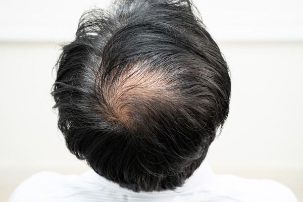 alopecie_androgenetique_quels_traitements_pour_freiner_la_chute_et_favoriser_la_repousse