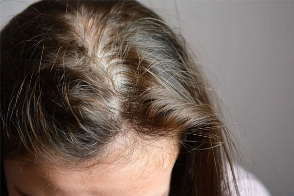 alopecie_androgenetique_quels_traitements_pour_freiner_la_chute_et_favoriser_la_repousse
