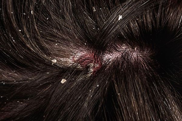 dermatite_seborrheique_du_cuir_chevelu_pellicules_demangeaisons_et_chute_de_cheveux